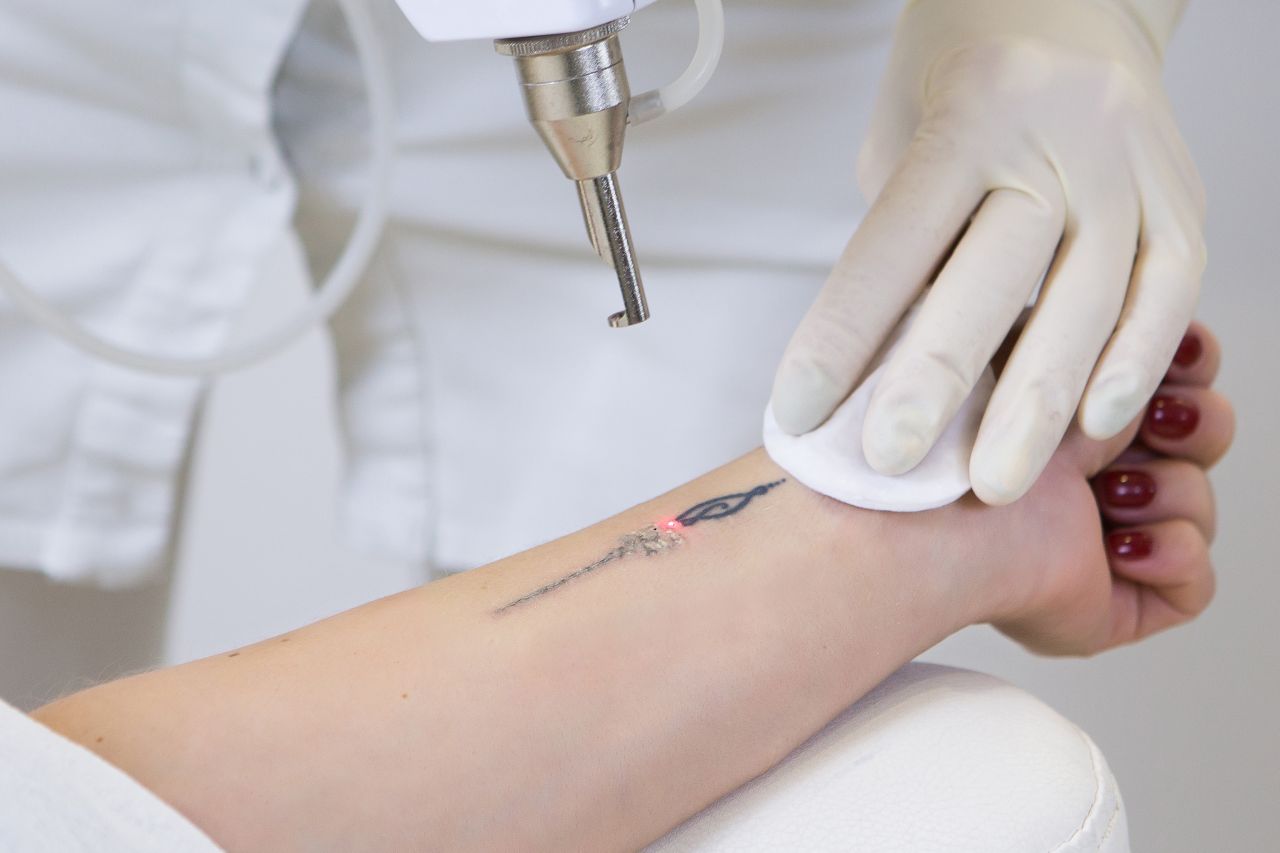 Jak wygląda proces usuwania tatuażu – co warto wiedzieć przed wykonaniem takiego zabiegu?